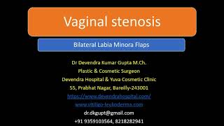 Vaginal Stenosis: Bilateral Labia Minora Flaps