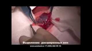 Варикоцеле / varicocele