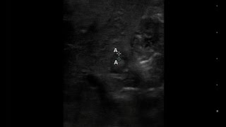 Projectile Vomiting in a 7 week old Baby Girl