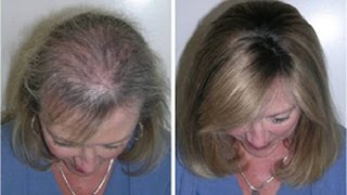 Como fazer o cabelo parar de cair e crescer muito mais rápido e resistente c/ esta receita caseira