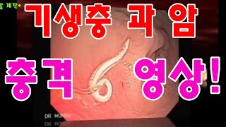 기생충과 암 /충격영상 기생충에 의한 암덩어리 /알벤다졸 펜벤다졸 메벤다졸