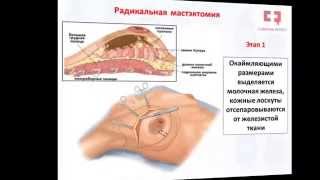 Рак молочной железы операция: лампэктомия, секторальная резекция, радикальная мастэктомия