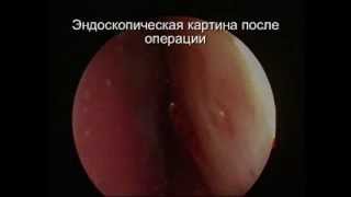 Иссечение синейхий полости носа, Эндоскопическая гайморотомия