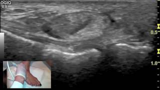 Ultrasound tutorial - Imaging of the Calcaneofibular Ligament