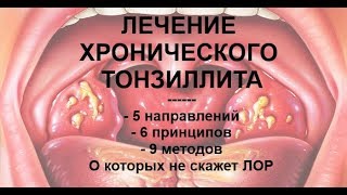 Хронический тонзиллит. История моего выздоровления после 20 лет мучений.