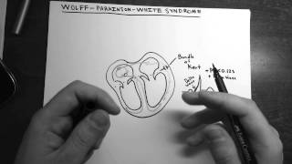Wolff-Parkinson-White Syndrome