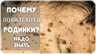Почему появляются родинки на теле?