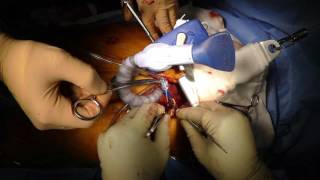 MICS CABG      Distal anastomosis