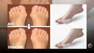 тренажер для косточки на ноге

  - valgus pro применение
