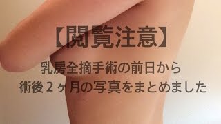 【閲覧注意】乳がん「左乳房全摘・同時再建」手術前日から術後2ヶ月までの乳房の写真をまとめました