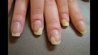 Bí quyết tẩy sạch nấm và làm trắng móng tay