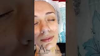 Trattamento dermopigmentista microneedling Philings
