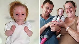Doktorlar Yaşamaz Dedi Ama 10 Yıl Sonra Olanlar Herkesi Şok Etti Parmak Kız Charlotte