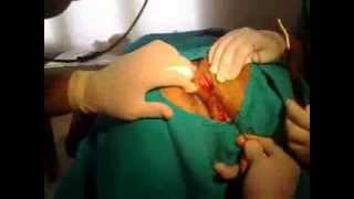 Komplike Kıl Dönmesi Ameliyatı - Op. Dr. Taner Bayramoğlu Hemoroid.Org