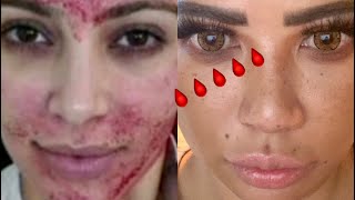HATE MY FACE: Juverderm+Vampire Facial