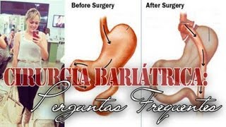 Cirurgia Bariátrica: Perguntas Frequentes