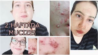 2 HAFTADA TÜM SİVİLCELERİMDEN SADECE “1” LİRAYA NASIL KURTULDUM! CİLDİMİN MUCİZE SIRRI!
