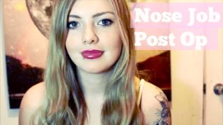 External Rhinoplasty Experience | 8 Months Post Op Update