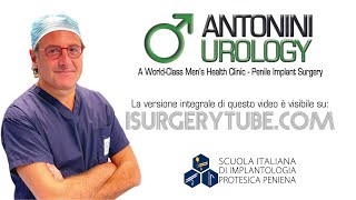 Attivazione Protesi Peniena Idraulica Gabriele Antonini Urologo Roma