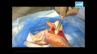 Лечение ран личинками. Диабетическая стопа / Maggot debritment therapy. Diabetic foot