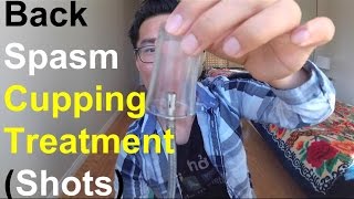 Back Spasm (Shot Glass Technique) Old Chinese Cupping Therapy