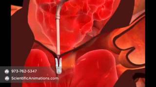 Mitral Valve Repair Surgery - Cardiac Animation