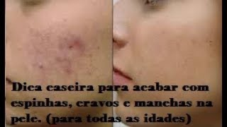 Espinhas, cravos e manchas na pele, tratamento caseiro