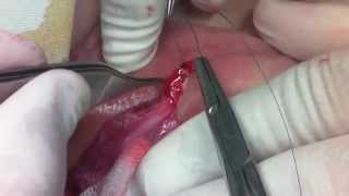 Pediatric Uro-Surgery Done by M.Elbarbary MD