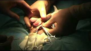 Лазерно обрязване при фимоза, Хил клиник Laser Circumcision