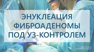 Удаление фиброаденомы груди по УЗ-контролем. Энуклеация фиброаденомы