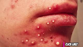 Blackhead King - How to Use Pimple Popper Tools