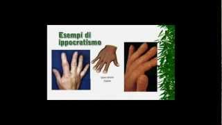 SINTOMI E SEGNI DEI TUMORI AL POLMONE