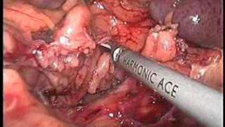 Cancer de colon en angulo esplenico