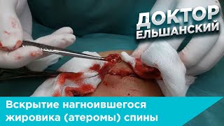 Вскрытие нагноившегося жировика (атеромы) спины