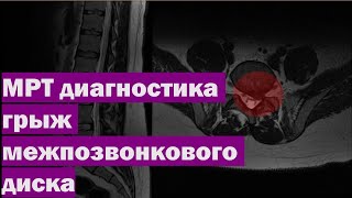 МРТ диагностика грыж межпозвонкового диска