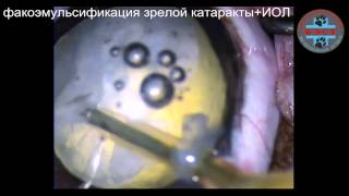 Катаракта йорк+ИОЛ
