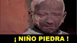 El niño que se esta convirtiendo en una PIEDRA !