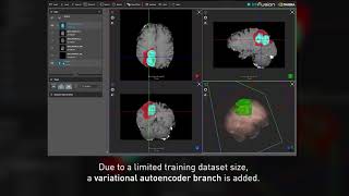 Research at NVIDIA: 3D MRI Brain Tumor Segmentation Using Autoencoder Regularization