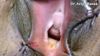 Vaginoplasty with Hymenoplasty by Dr.Avijit Basak