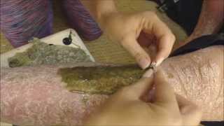BRAZILIAN WAX KIT VS PSORIASIS | Part Deux