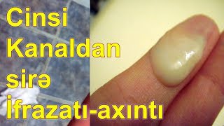 Prostat Şirəsi haqqında bilmədikləriniz.