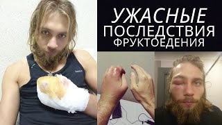Ужасные последствия фруктоедения: две операции - как этого избежать