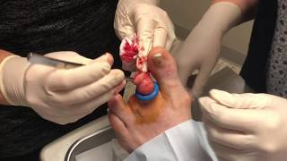 Partial Toe Amputation