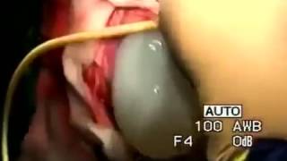 beyindən parazitlərin şişin çıxarılması 18+