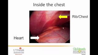 Pediatric Chest Deformities   Pectus   Webinar