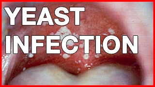 Symptoms of Chlamydia in Men and Urethritis & Pictures