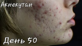 50 дней с Акнекутан(роаккутан)! ЦЕНА лечения! Новые побочки? УЛУЧШЕНИЕ? Акне| Прыщи|
