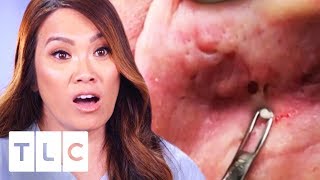 Dr. Lee Removes Multiple Blackheads From Patient's Face | Dr. Pimple Popper: This Is Zit