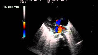 Echocardiography study by Prem C Jha AMIAE (Ravindra Hospital & Heart Centre Hisar)