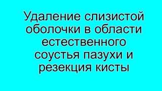 Эндосокопическое удаление кисты (киста основной пазухи)
